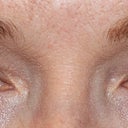 My "before" picture. Notice the heavy, hooded upper eyelids and the slightly angry, tired look.