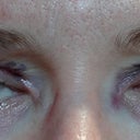 A few hours after the procedure. No pain at all.