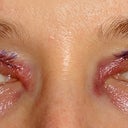 Day after the procedure.