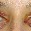 Four days after the procedure.