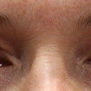 Two weeks after the procedure. No eye makeup on. Very little bruising, and for the first time in years...eyelids!