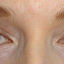 My lovely new eyelids. 3 weeks post-surgery.