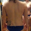 bra line/hips/back, 3 days post op.
