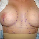 Boobies, one day post op(-: