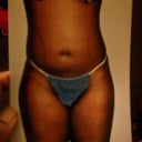 PRE OP front