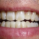 After Britesmile 48hours some staining appearing