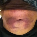 3 Days post Bruising