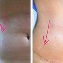 my one and only stretch mark (i know some of you are thinking BITCH PLEASE...) has moved south! i thought i was going to be rid of it but most of it is still there. that's from my son jordan who is now 20!