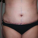 Front - 1 day post-op