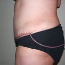 Side - 1 day post-op