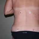 Back - 1 day post op