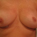 8 days post-op Immediately after bra removal.