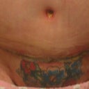 2 week's post-op