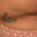 2 week's post-op