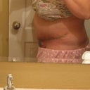 2 week's post-op