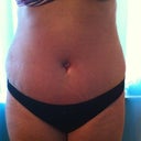5 days post op