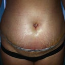 5 days post op