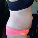 7 Weeks Post Op--u can see the lump on the left side bulging out from this view