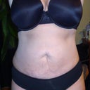 14 WEEKS POST OP