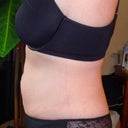 14 WEEKS POST OP