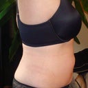 14 WEEKS POST OP....see the damn lump protruding...STILL
