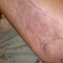 Day after surgery bruising