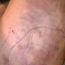 Day after surgery bruising
