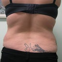 before- for the zerona