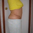 1 month post right
Early Morning before I swell up