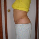 1 month post left
Early Morning before I swell up