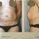 4 days Before surgery 18/1/13