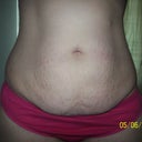 pre op
