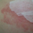 Ugh...tape irritation.