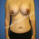 6 weeks, scars are healing nicely. Right implant slightly higher.