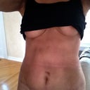 Another one at 3 weeks postop. Swelling and bruising releasing a little each day.