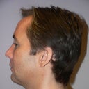 41 Year Old Man Gets Chin Implant Surgery