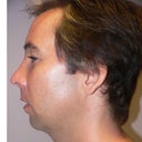 41 Year Old Man Gets Chin Implant Surgery