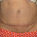 10 days after MTT
