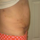 10 days after MTT