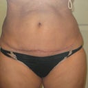 26 days after MTT