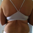 Pre-op back