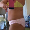 Pre-op left side
