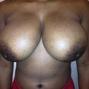 Pre-surgery 32F. They hardly fit in the frame : /