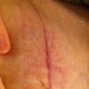 biodermis reaction??? and incision.