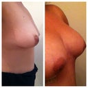 Before and 2nd day post op