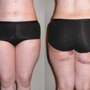 2 days post-op