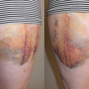 Bruises, about 4 days post-op