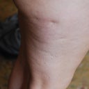 right lateral thigh, pre procedure