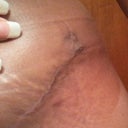 Wk6 TT-- Scar up close