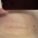 post-op day 45, scar...just a straight line, very flat, not dark at all, picture taken is the mirror image of the scar